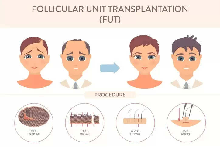 Which Type Of Hair Transplant Is Best - FUT or FUE?
