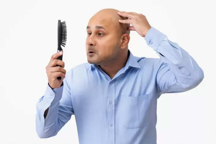 Male Pattern Baldness: Stages, causes, symptoms and all you need to know