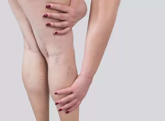 It’s Time To Laser Tag Your Spider Veins