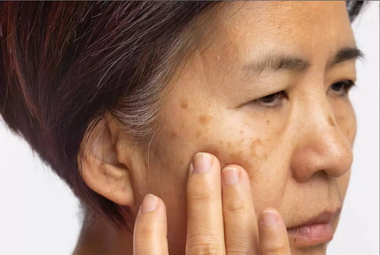 Skin Pigmentation Can Take A Toll On Your Confidence. Here’s How You Can Get Rid Of It