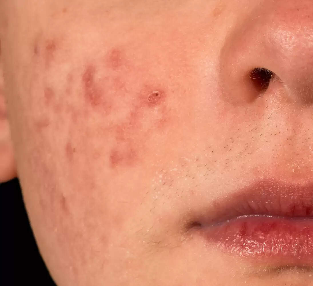 Worried about acne scars? Here’s how to fix them according to famous acupuncturists