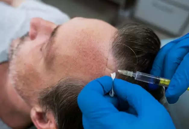 What is hair transplant procedure and how does it work ?