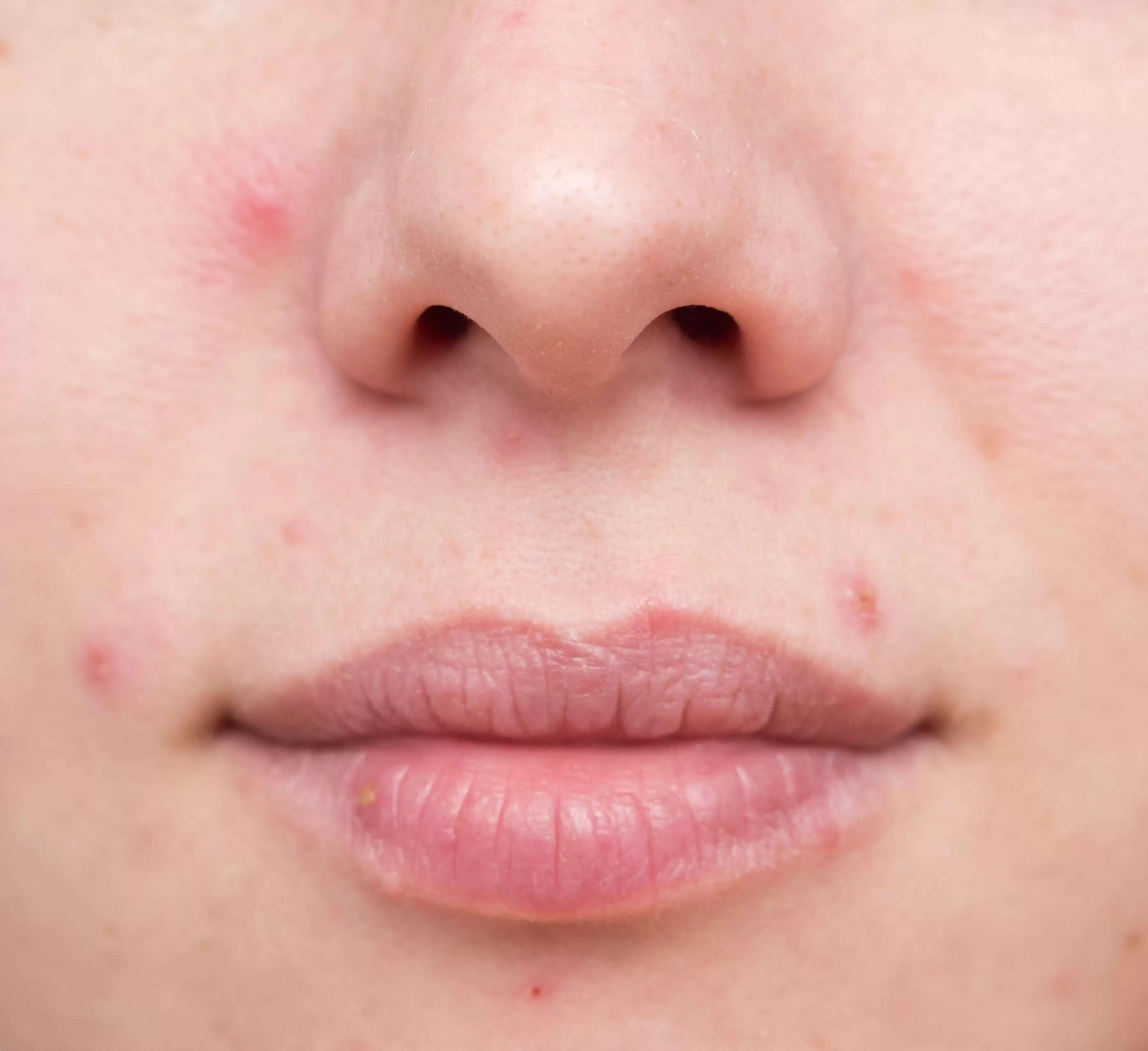 Relief from acne scars through simple effective treatments